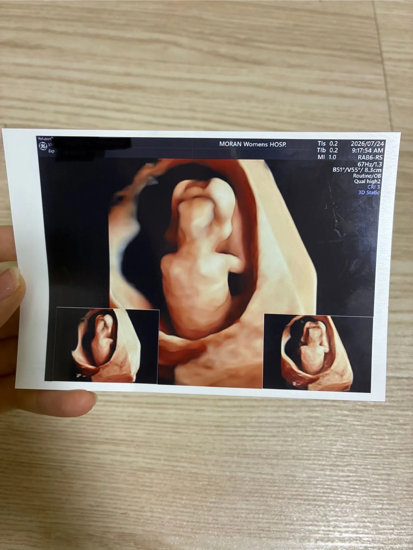 1차기형아검사 통과했는데 애기가 자고있으면.. 성별 예측 힘들죠? ㅜㅜ  1