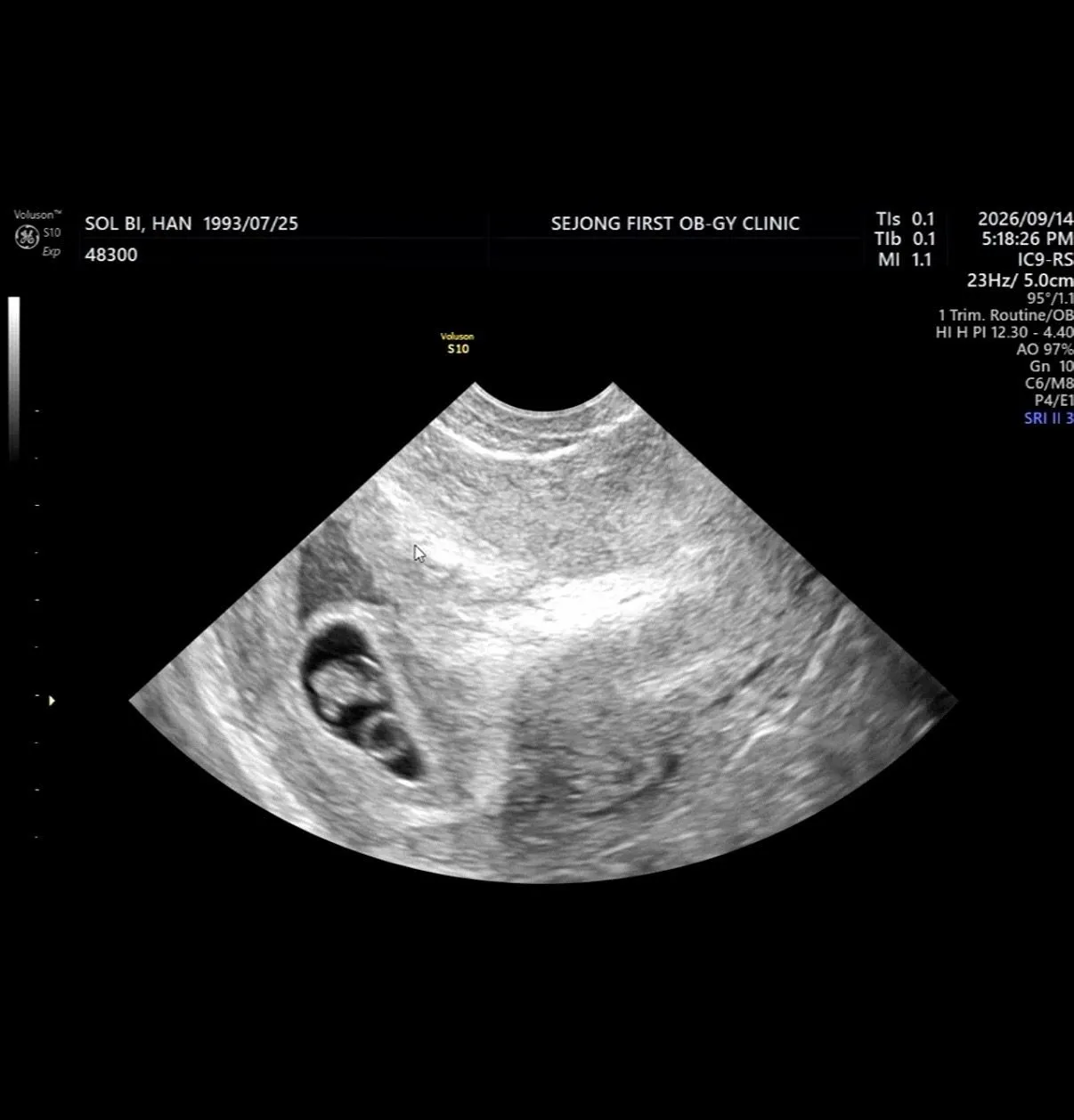 7주차 아기집 작음,,피고임