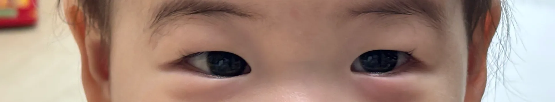 아기가 어린이집 다녀와서 눈이 밑에 부어있어요