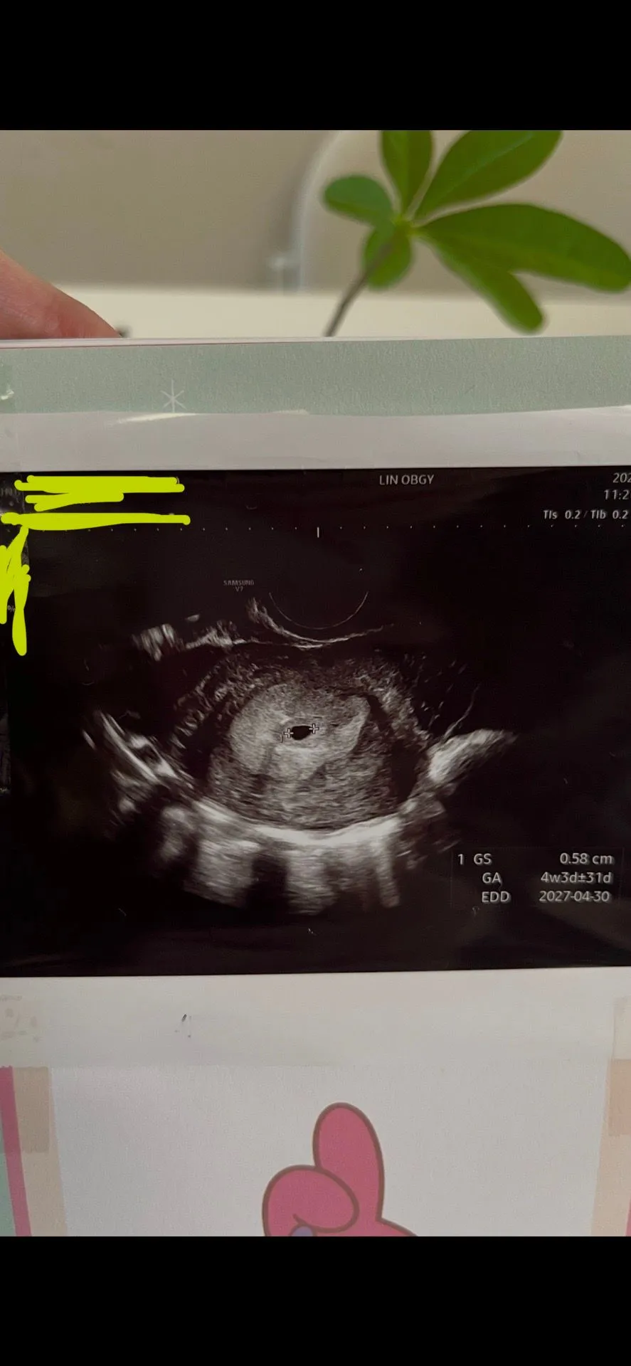 4주6일 아기집 위치가 아래쪽이라는데 괜찮을까요?ㅠㅠ 1