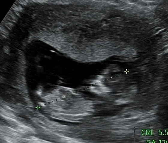 각도법 부탁드립니다👶🏻🩵💗 12주 3일차