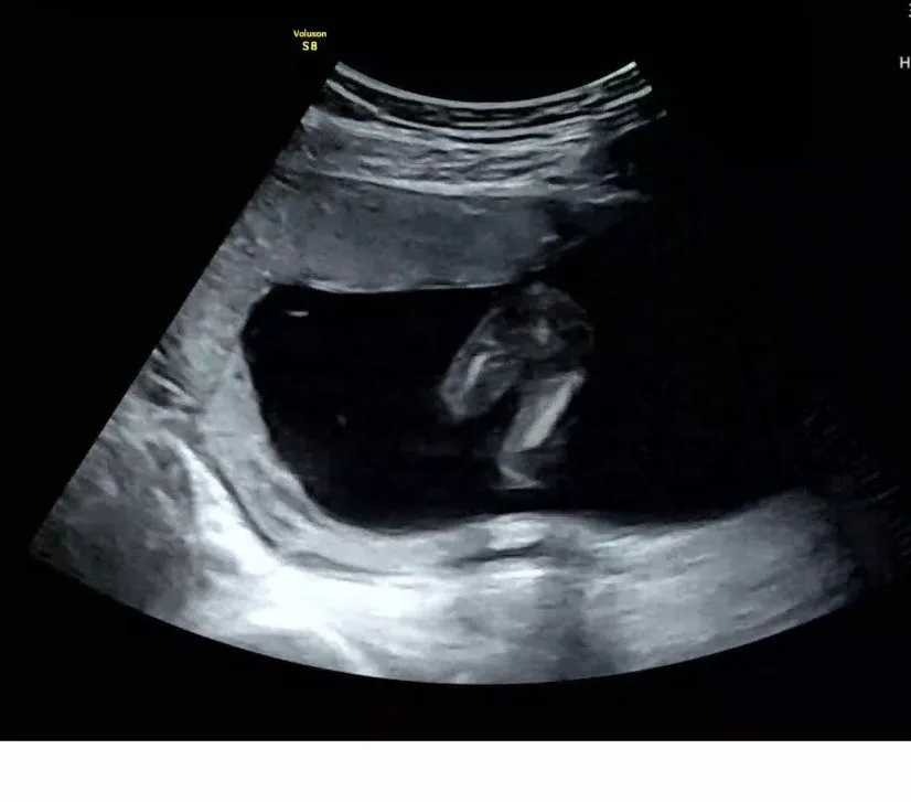 15주 5일 다리 사이 같이 봐주세요!! 5