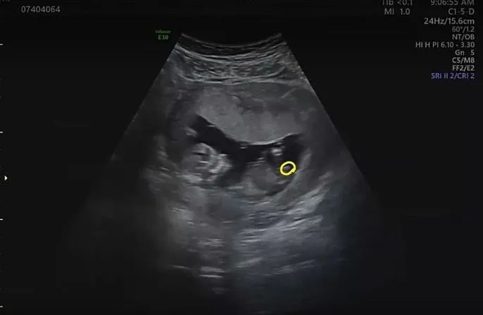 12주 1일 장꾸맘 각도법  2