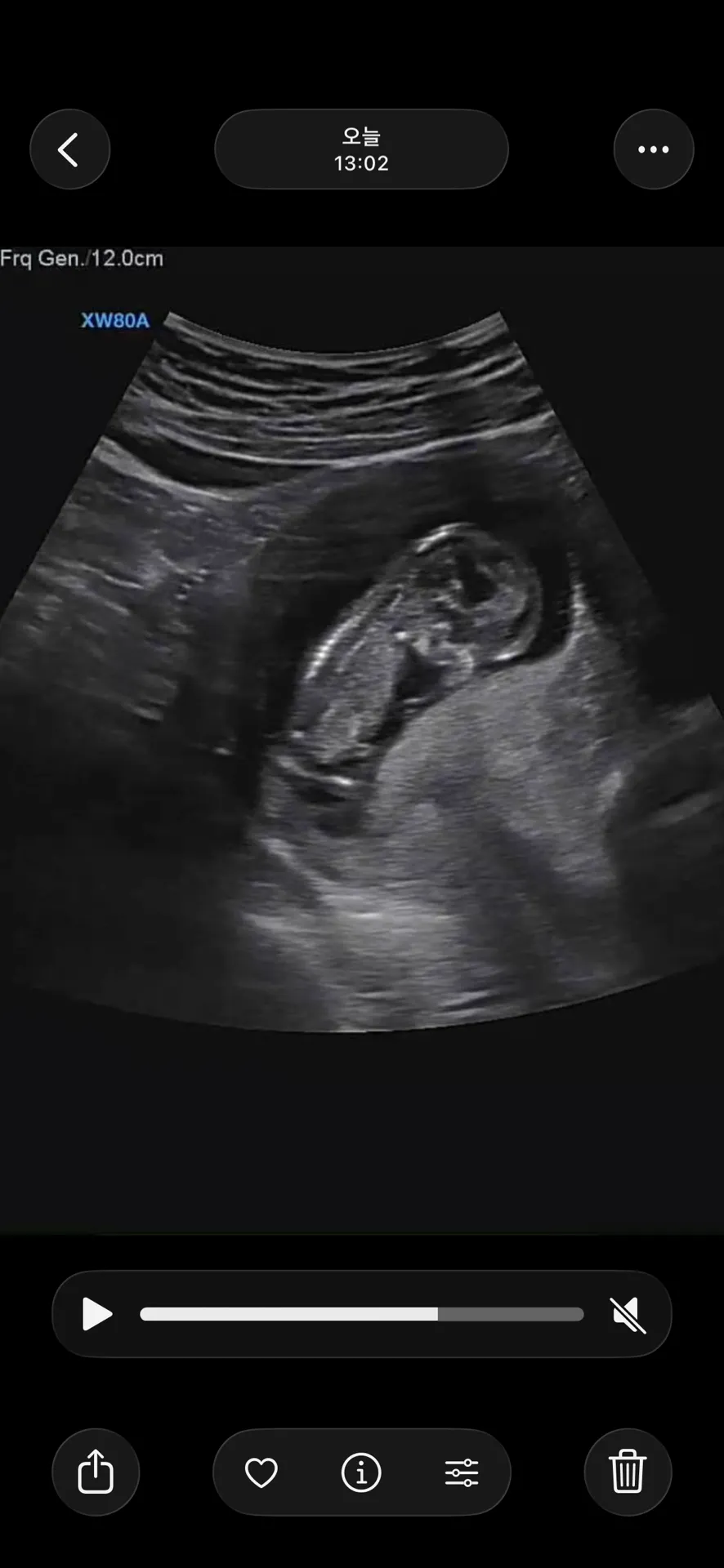 (12주2일) 초음파 성별 예측해주세요! 4