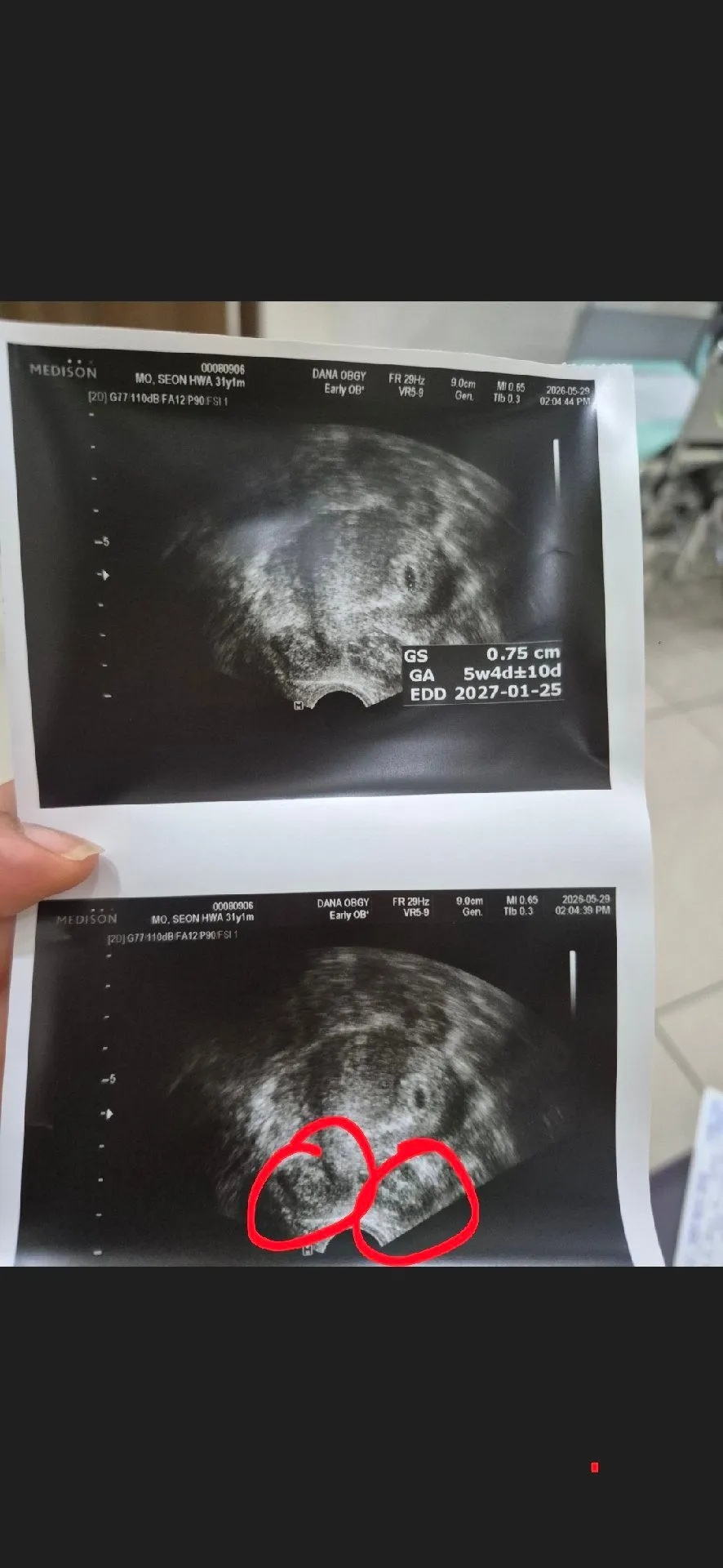 5주2일차 아기집보고옴. 근종이 있대요ㅠ