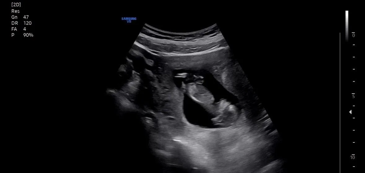 11주 6일차 사진 한번 봐주시면 감사합니다ㅠㅠ 2