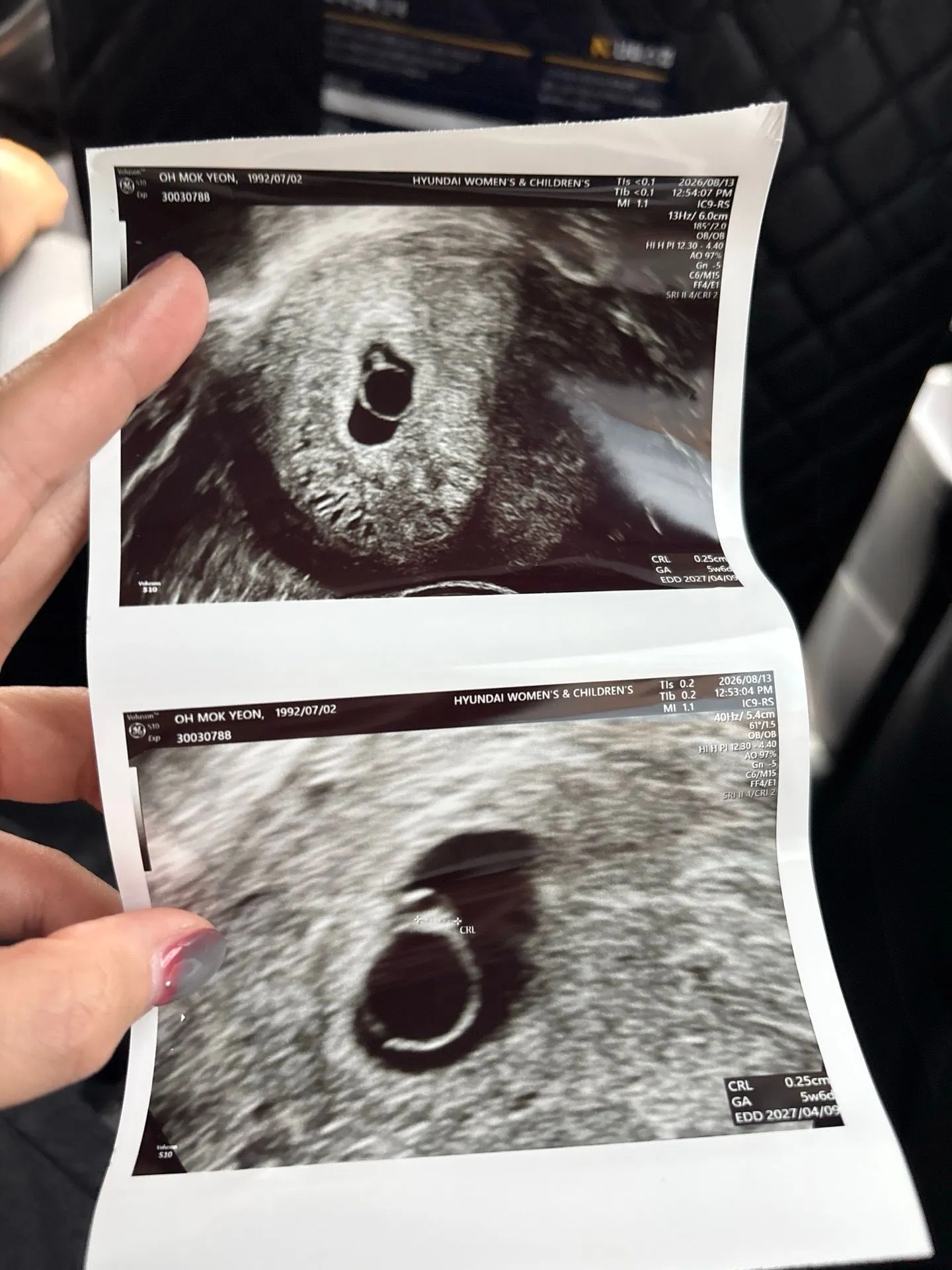 난황이 부어서 계류유산..? 초음파 봐주세요