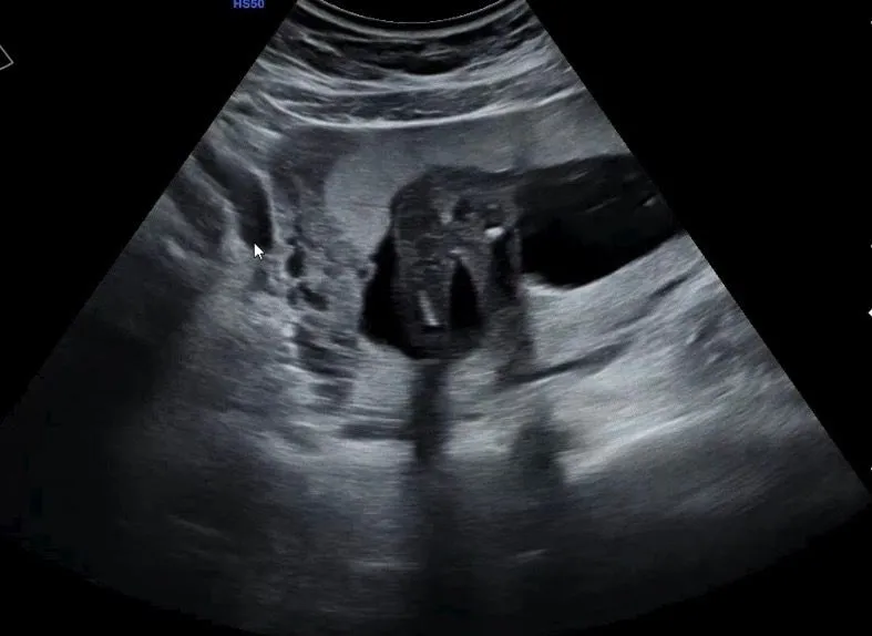 16주 6일 성별!! 2
