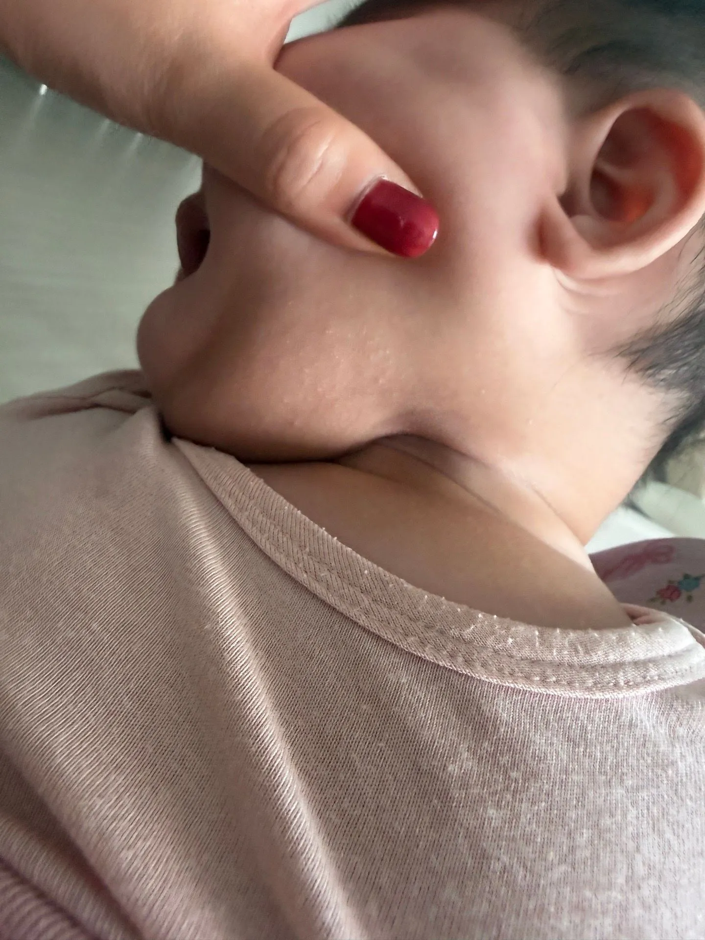 아기 목에 두드러기?