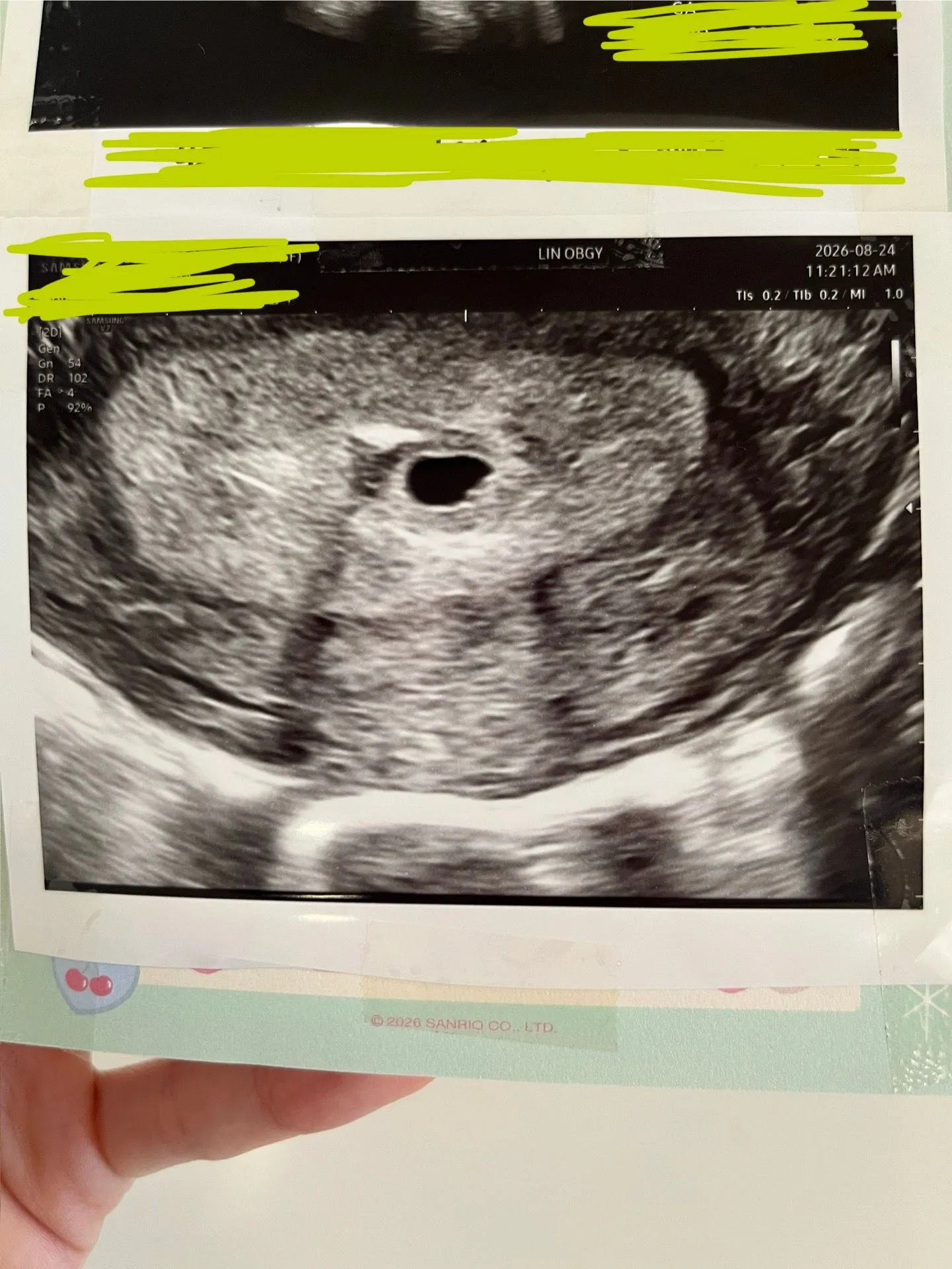 4주6일 아기집 위치가 아래쪽이라는데 괜찮을까요?ㅠㅠ 2