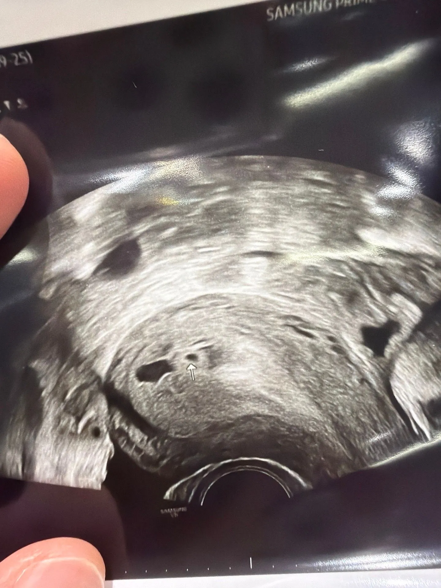 4주 6일 초음파👼🏻