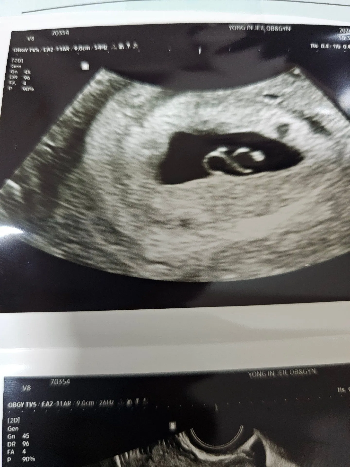 일란성쌍둥이 1