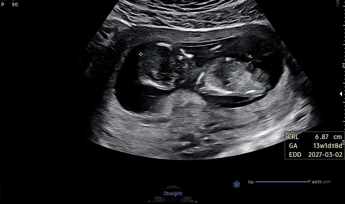 12주 너뮤궁금해요 !!! 아들 딸 각도법 보시는 분 !!🍼🍼