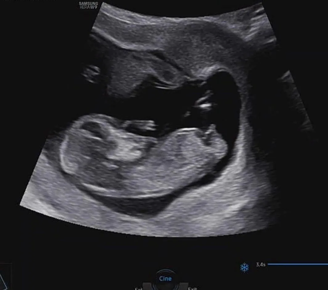 12주2일 각도법 성별 봐주세요❤️