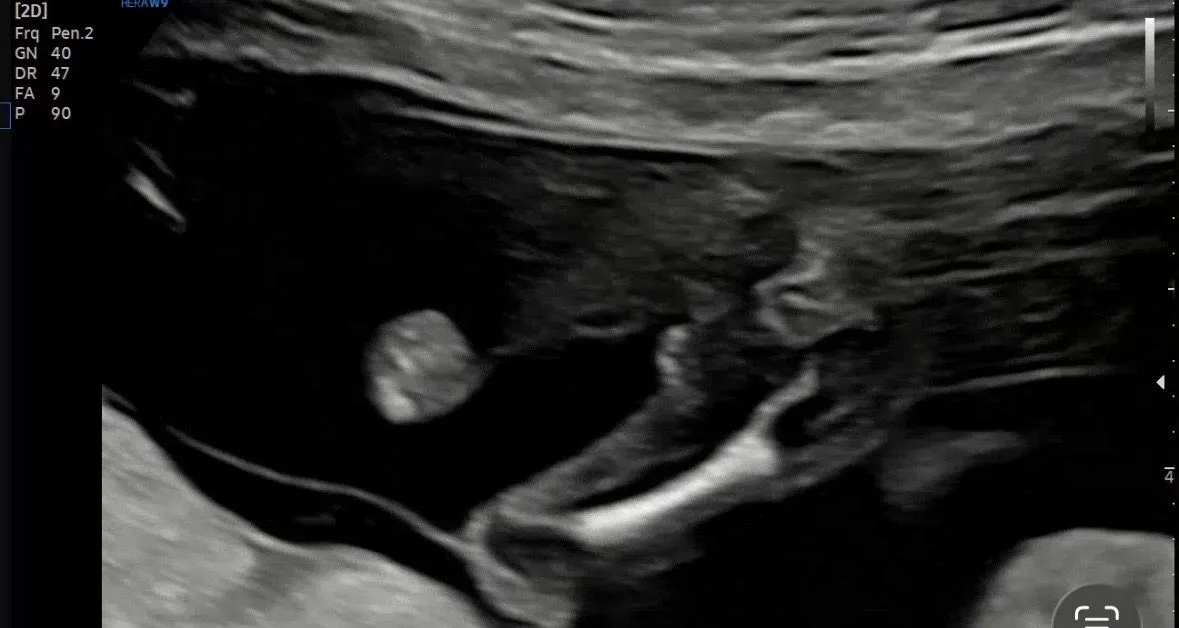 14주 3일차 쌍둥이 성별이 뭘까요? 2