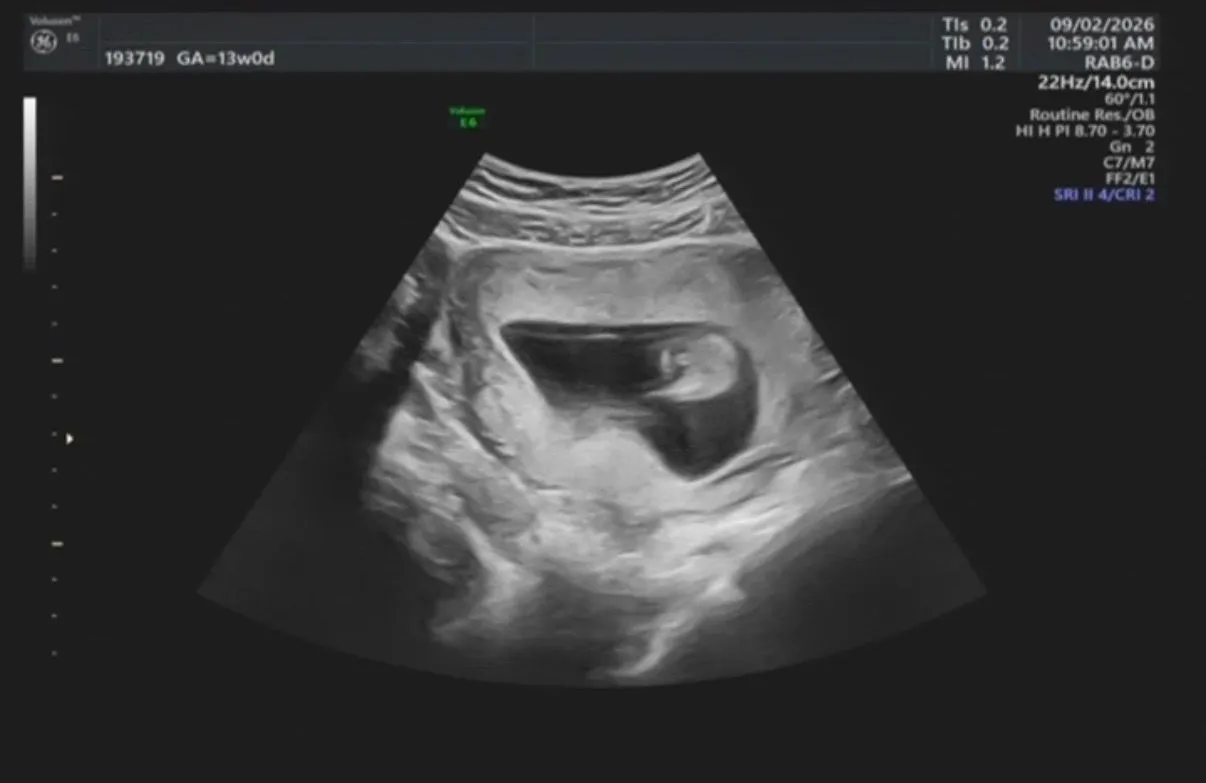 13주 1일차 성별 그리고 양수양이.. 3