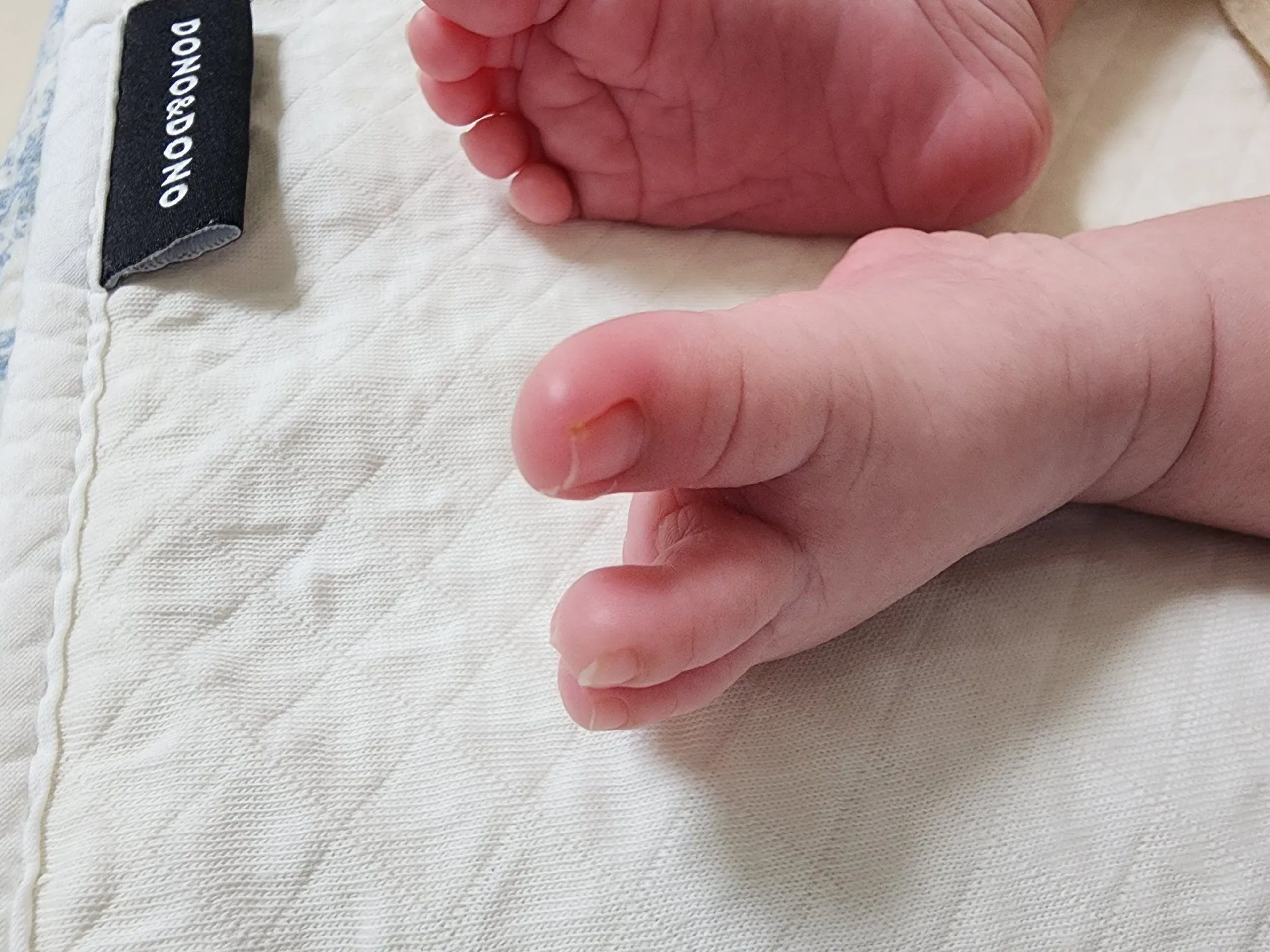 엄지발가락이 부었는데 소아과 가면 되나요? 1