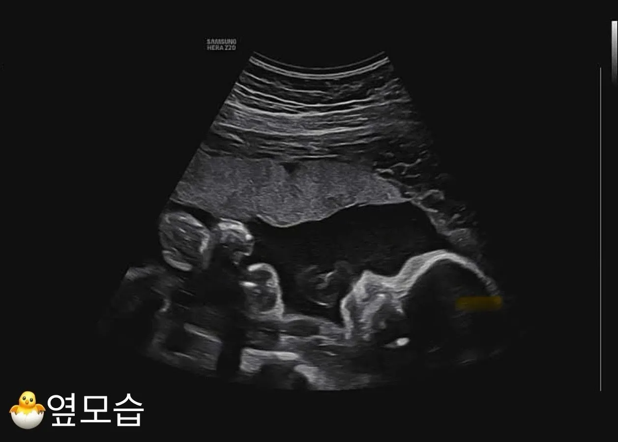 24주 입체정밀춈파 좋네요..♥︎  2