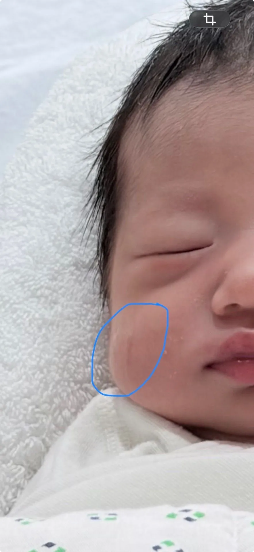 신생아 얼굴 상처 좀 봐주세요ㅠㅠ