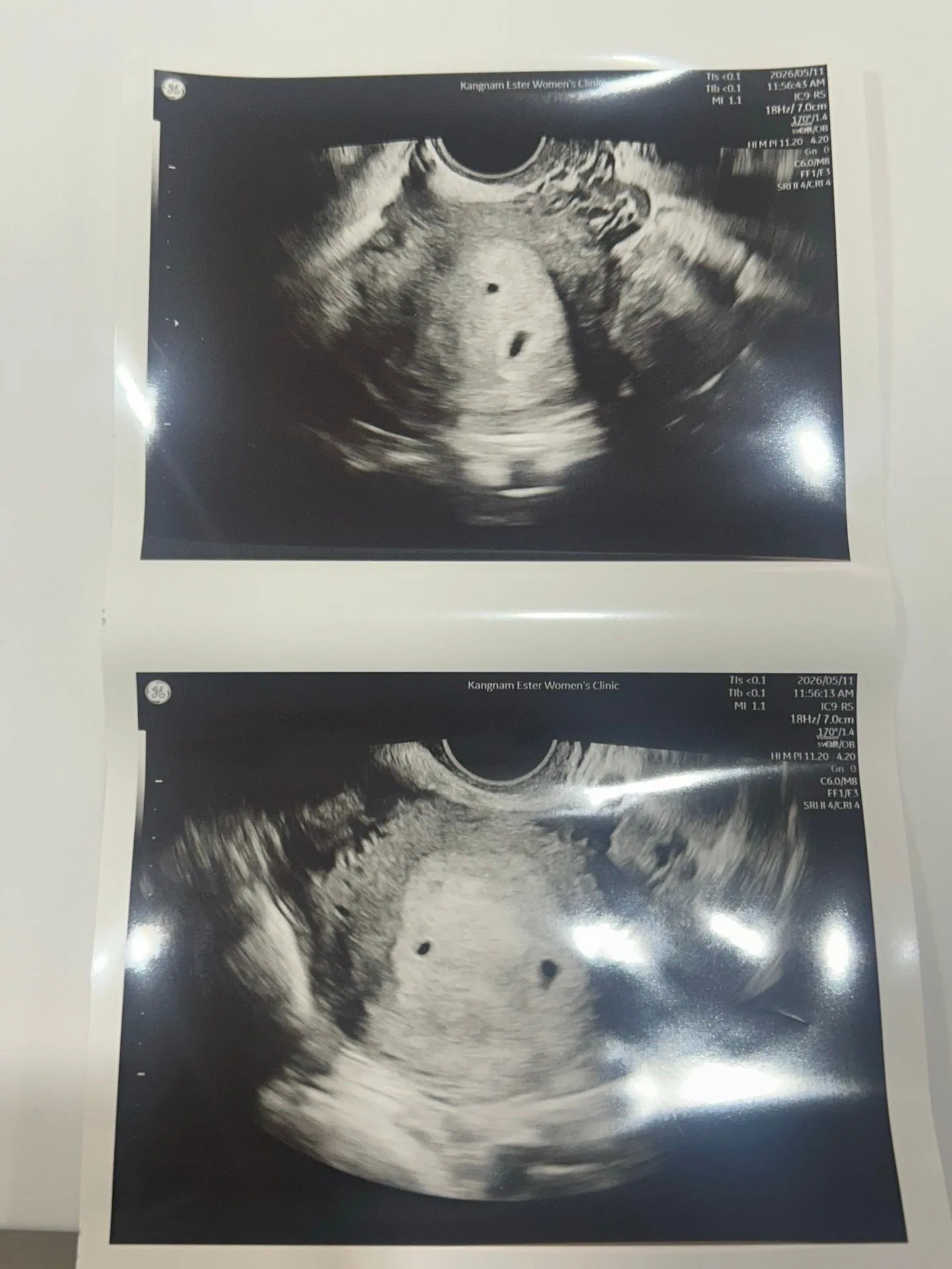 쌍둥이 초음파