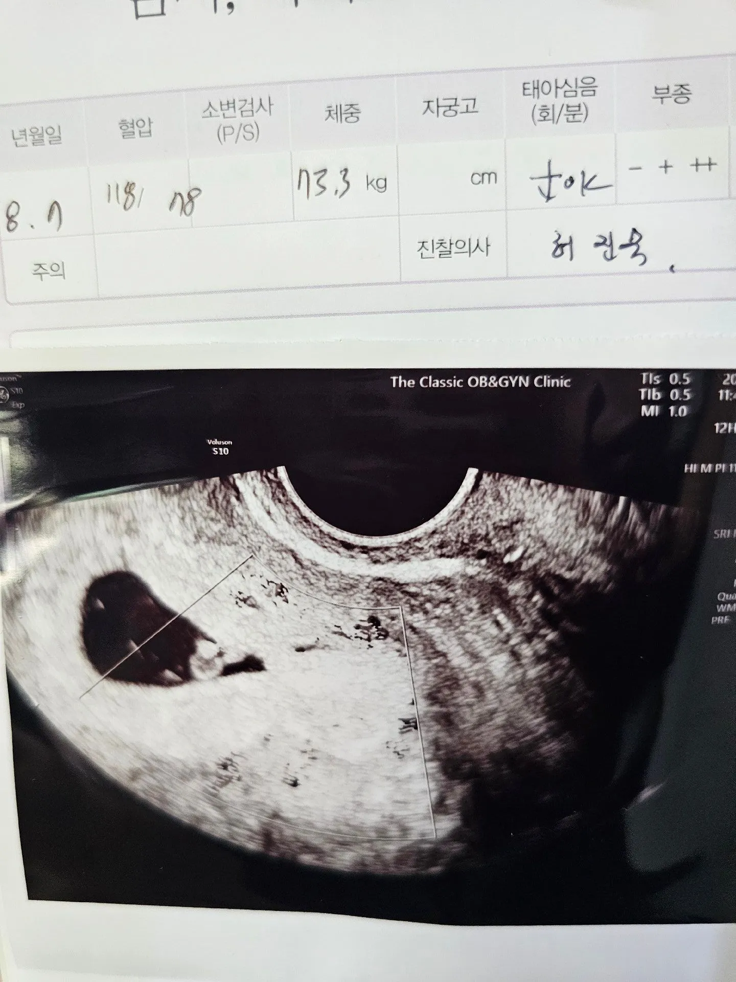 심장소리듣고왔네요보석반지같이 생겼어요 초파사진 1