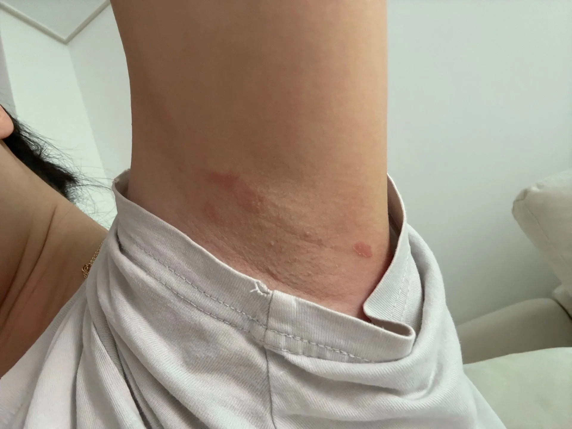임산부 겨드랑이 습진
