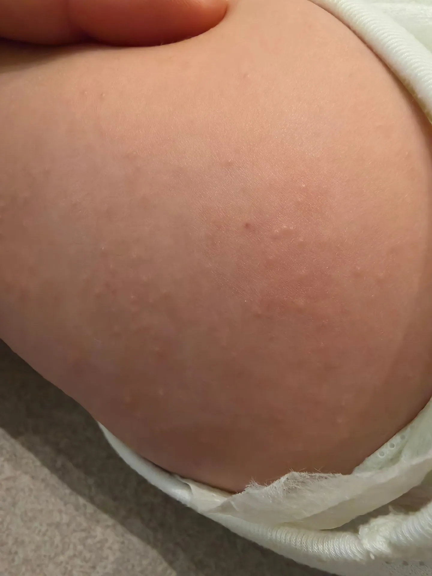 130일 지난 여아 오돌토돌 피부?? 2