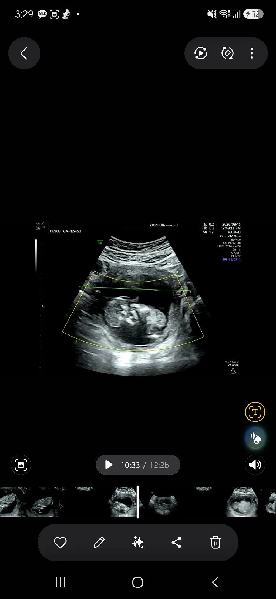 12주5일 차에 1차기형아 검사했는데 성별이알고싶어요 ㅜㅜ 1