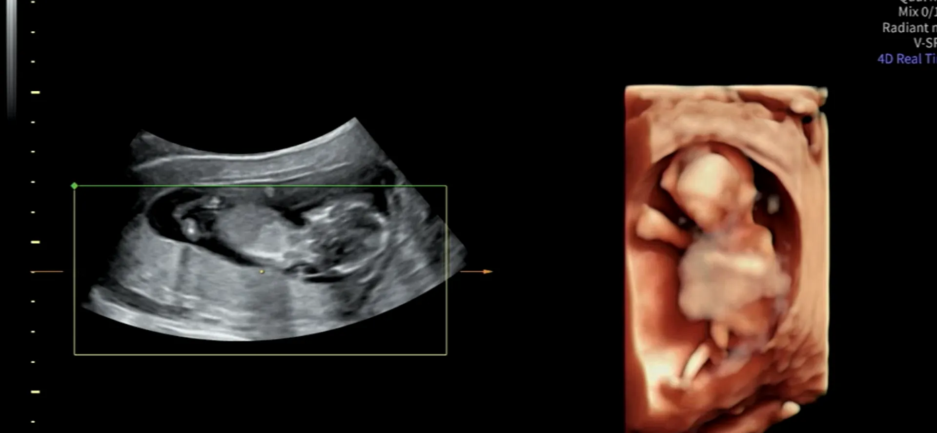 12주차 성별 봐주세요👶🏻😭 5
