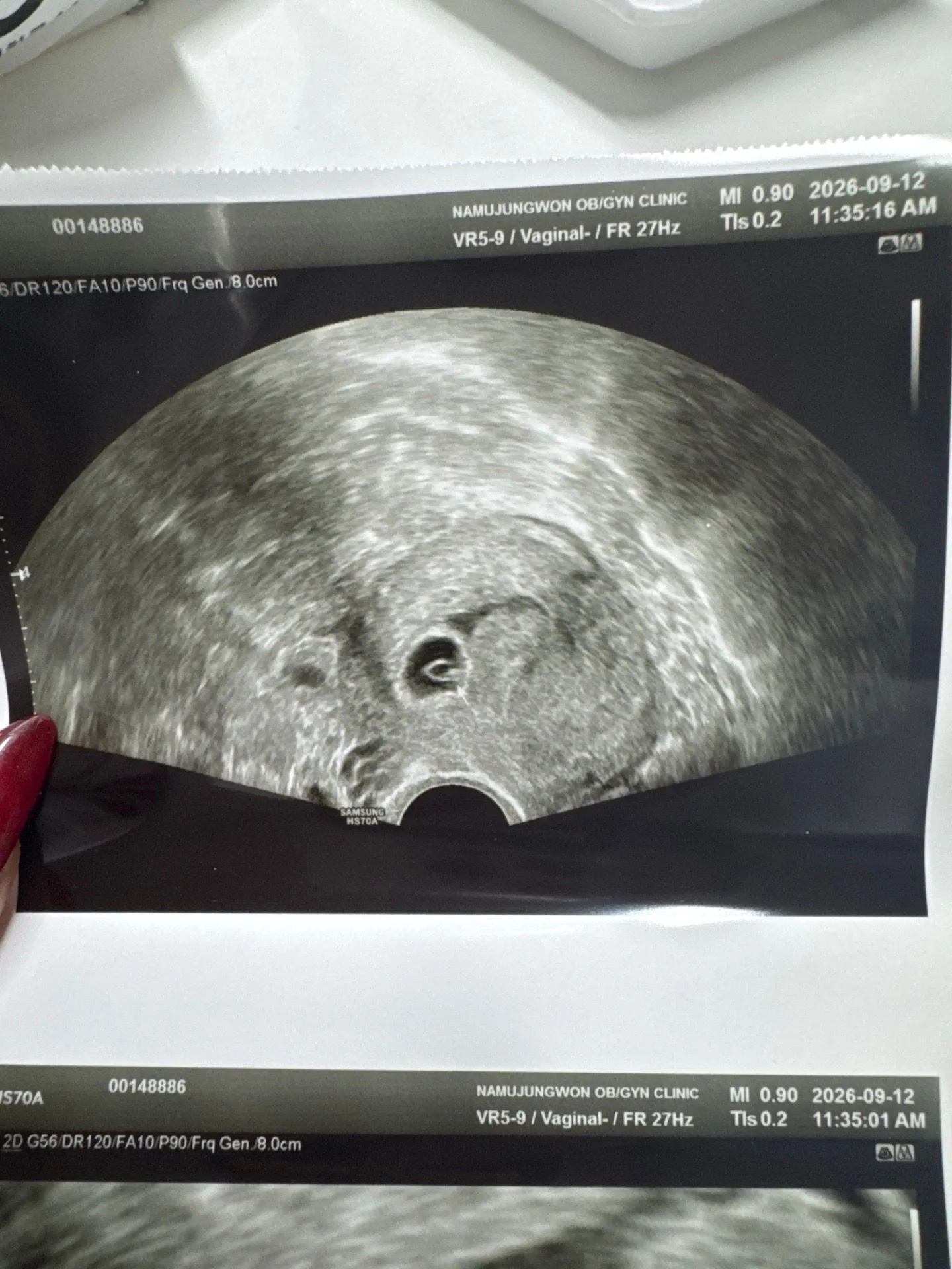 7주5일 심장소리 못들으신분게신가요..?