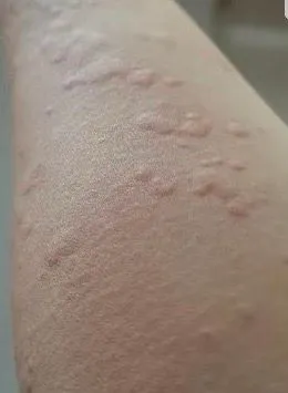 임신 소양증 너무 힘들어요