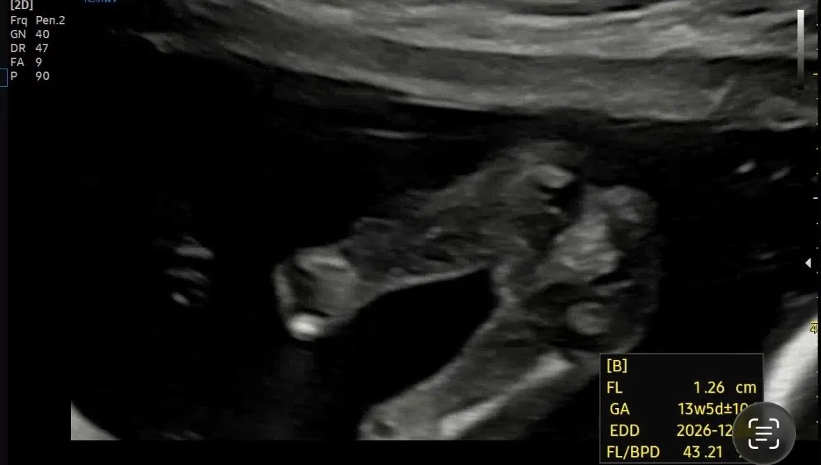 14주 3일차 쌍둥이 성별이 뭘까요? 3