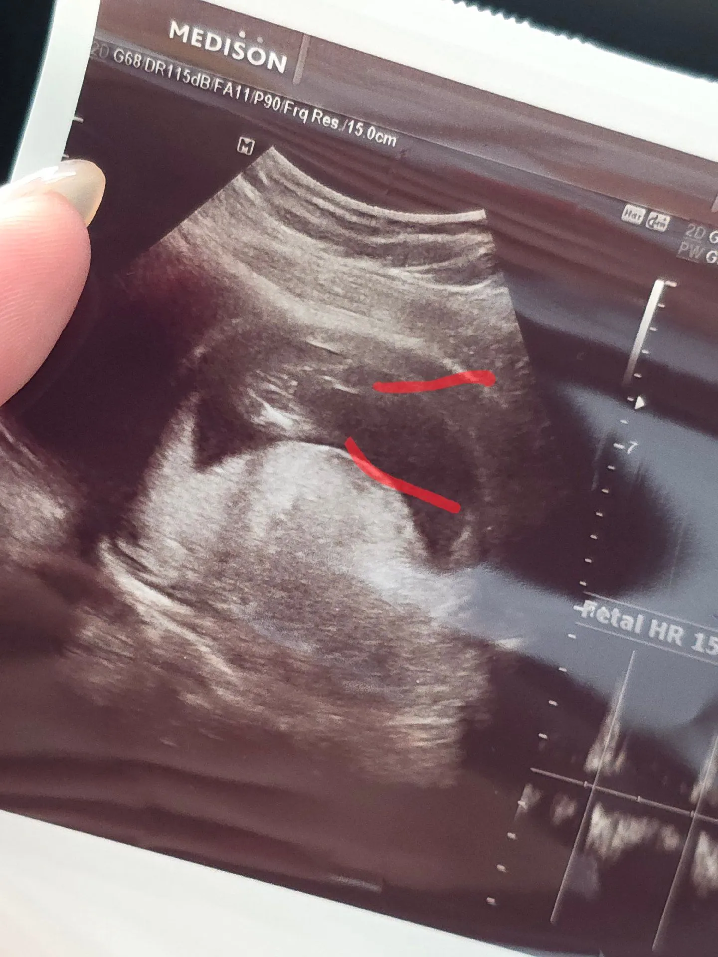 15주 다리사이 사진 봐주세요ㅠㅠ(사진재첨부)