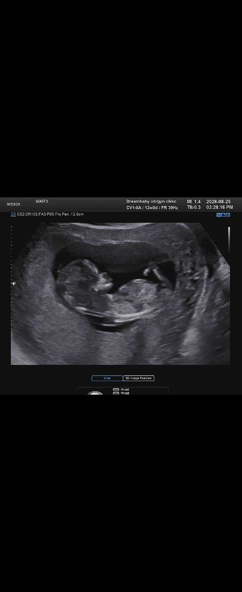 12주0일초음파 성별좀봐주세요ㅠㅠ 1