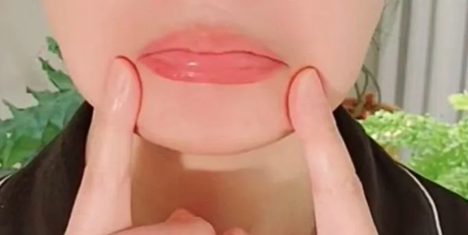 입꼬리 처짐