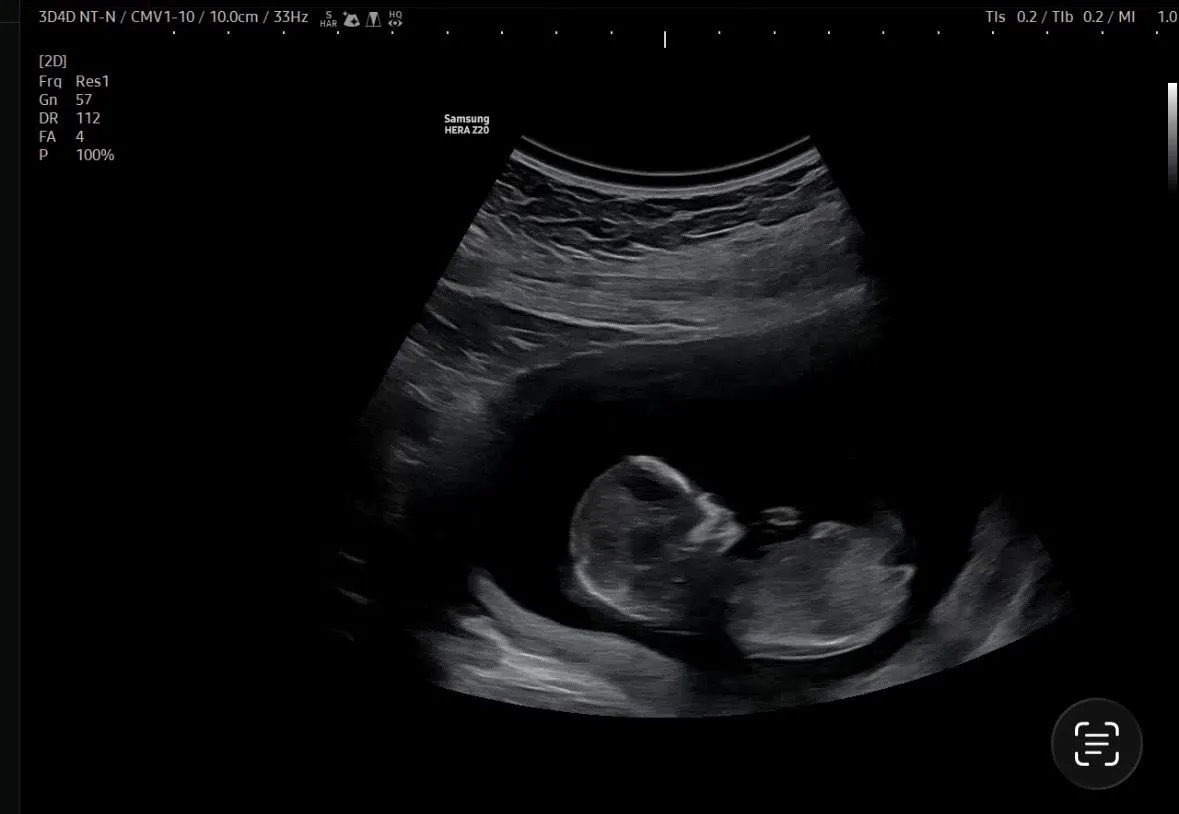 12주4일 각도법 마구마구 성별 유추해주세요🥲 3
