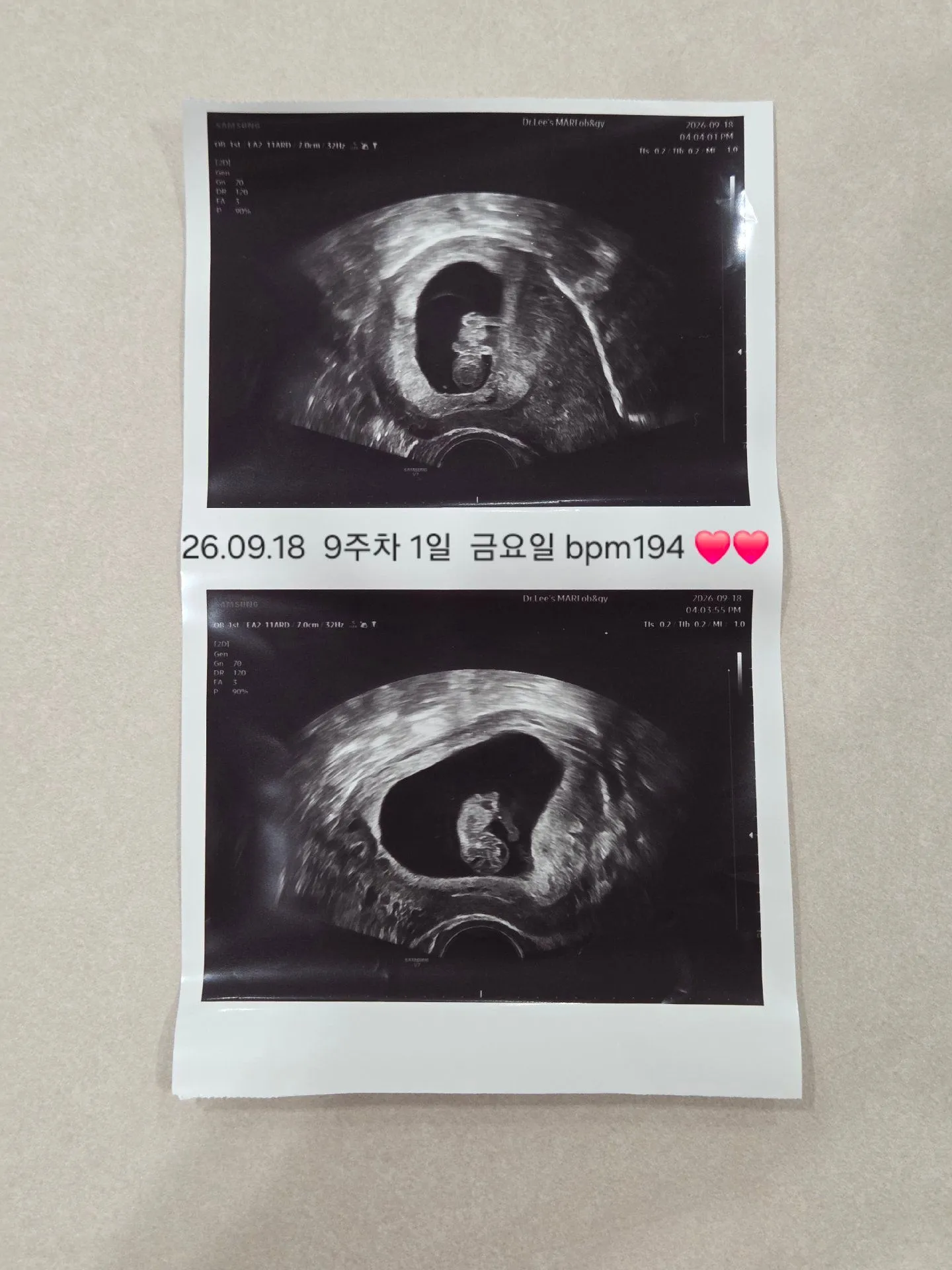 아직 9주1일차 심박수가 높아서 고민이예요 1