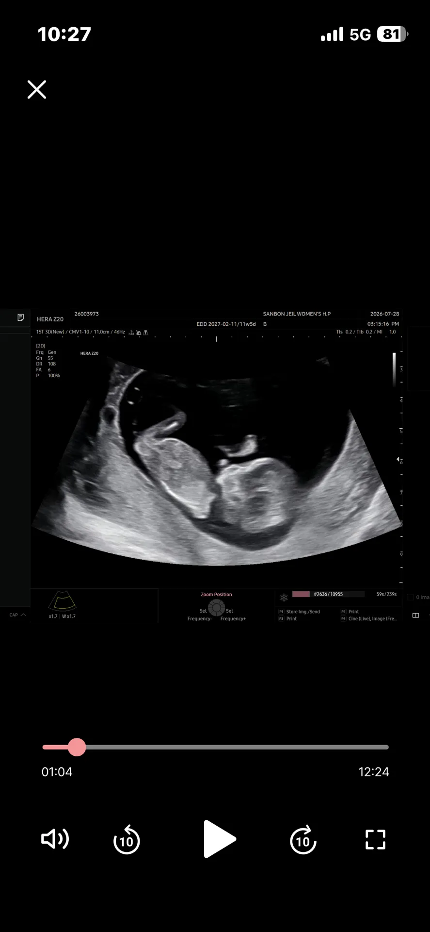 12주 2일 각도법 성별 봐주세요ㅠㅠ 첫째