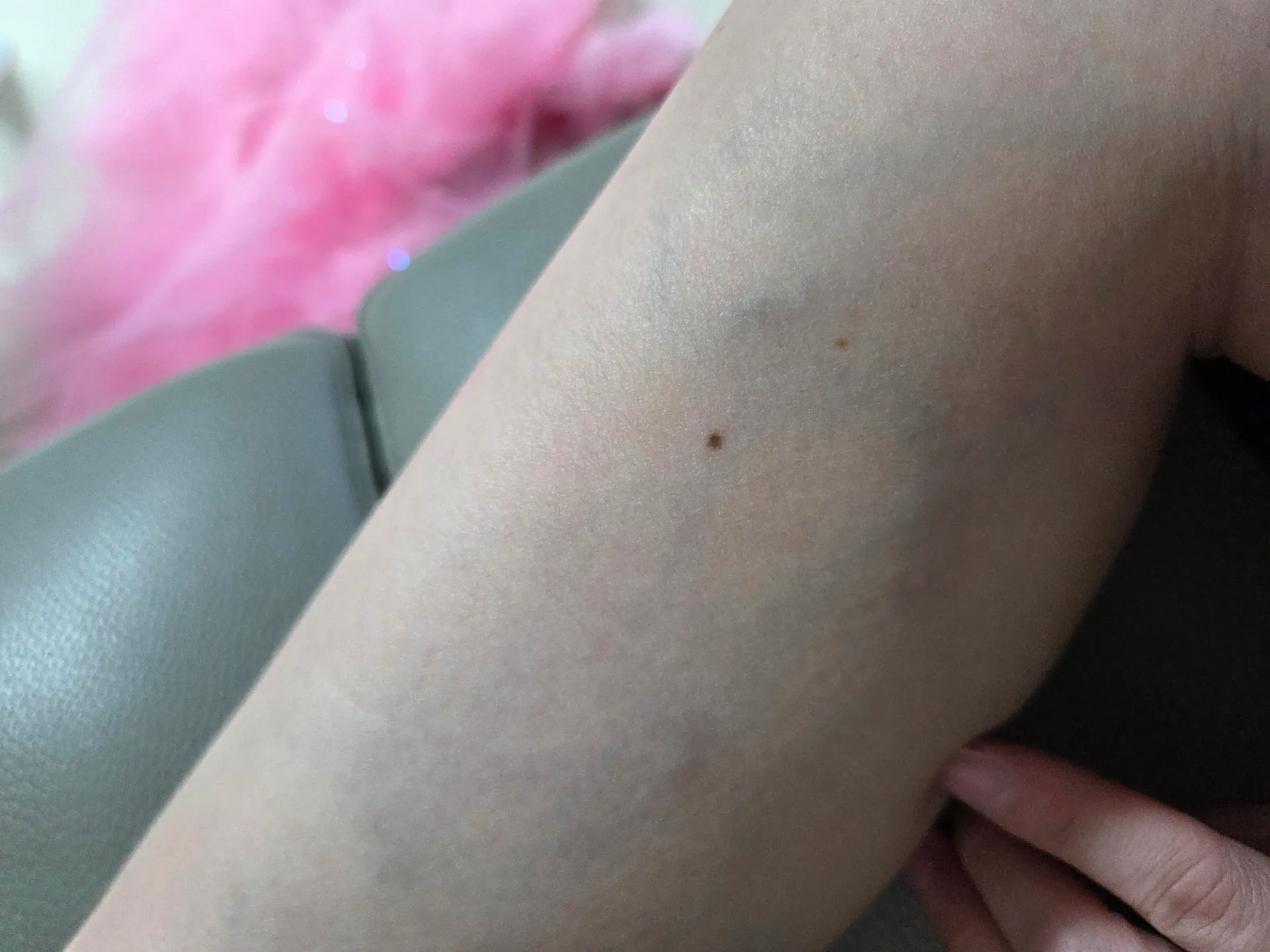 하지정맥? 혈전? 혹시 어느병원가야하는지 아시나요ㅠㅠ 2