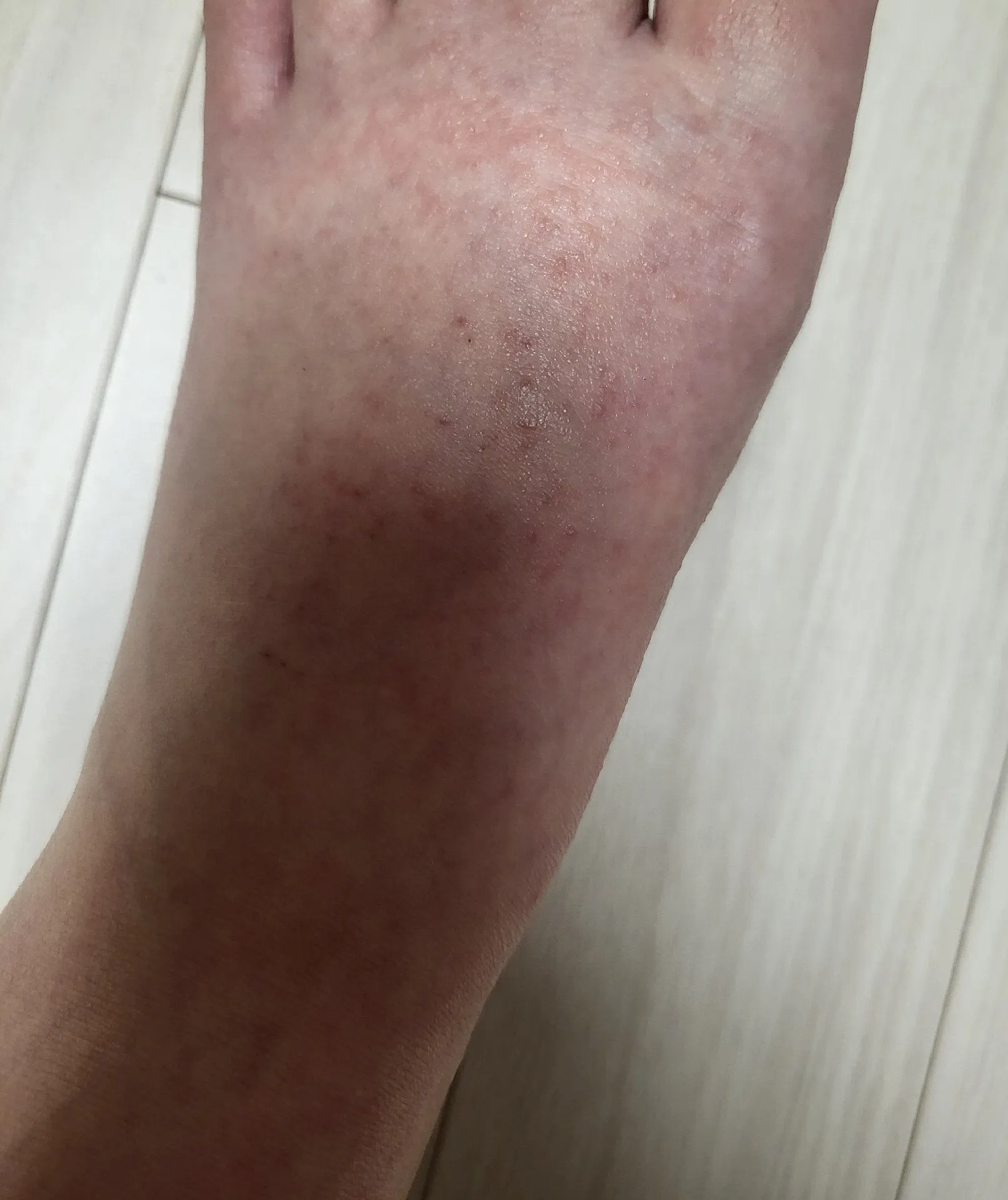임산부 두드러기 도와주세요 ㅜㅜ 2