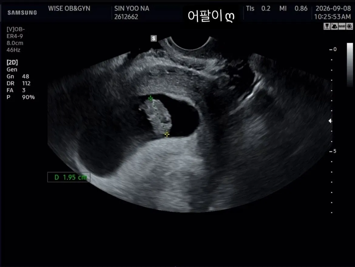 8주4일 초음파보고왔어요!