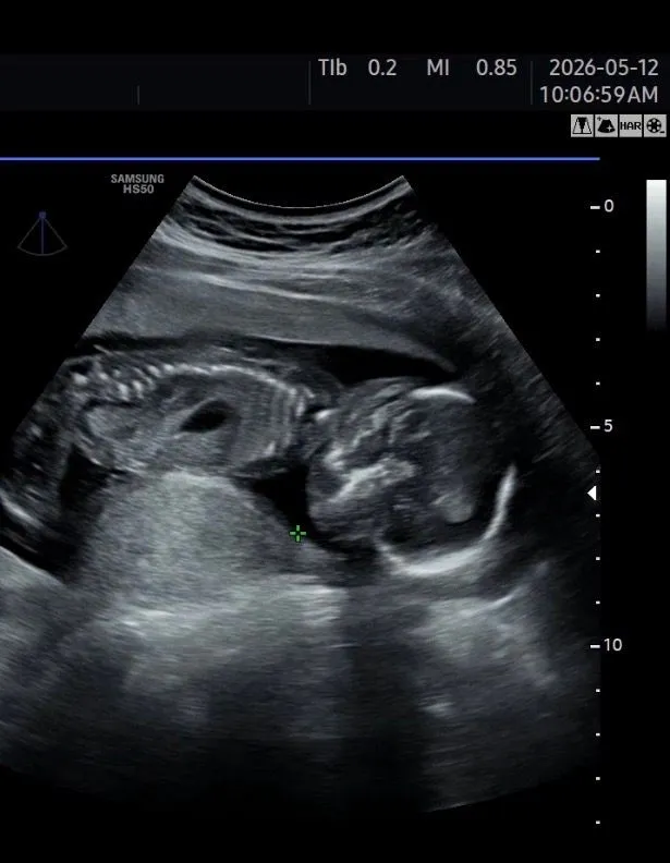 16주 6일 성별!! 1