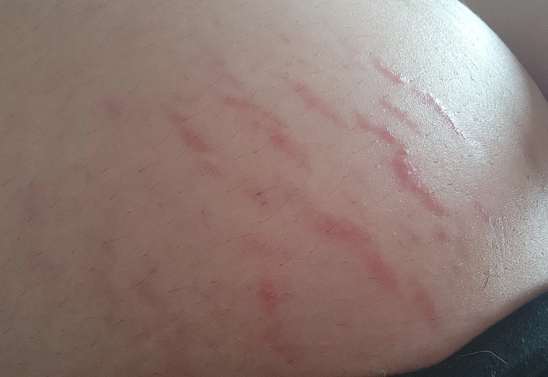 배 튼살쪽에 혹시 소양증인걸까요..?? (사진첨부) 2