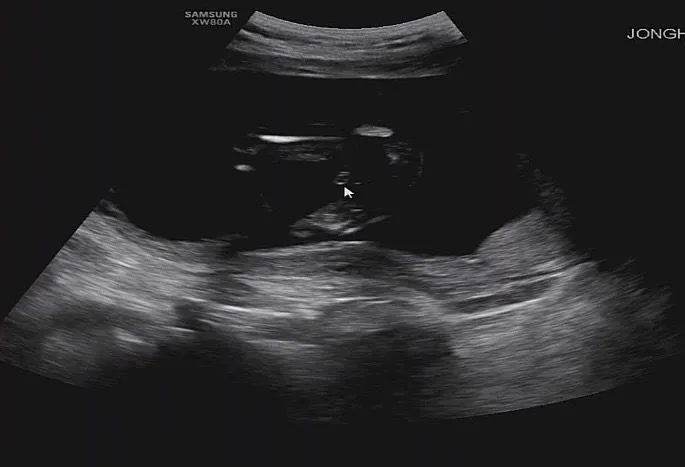 17주1일 촘파 성별