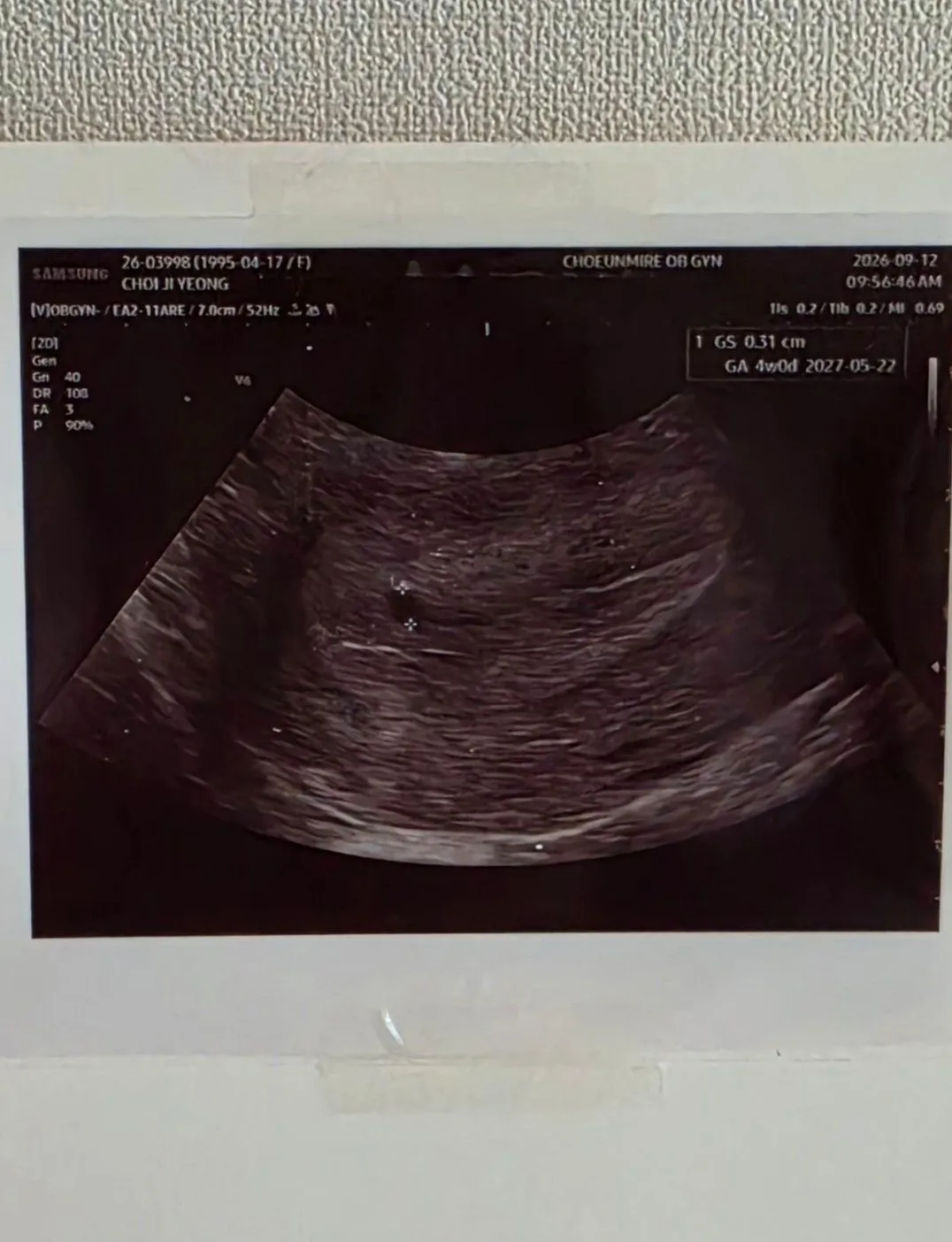 4주 0일 아기집 0.3cm