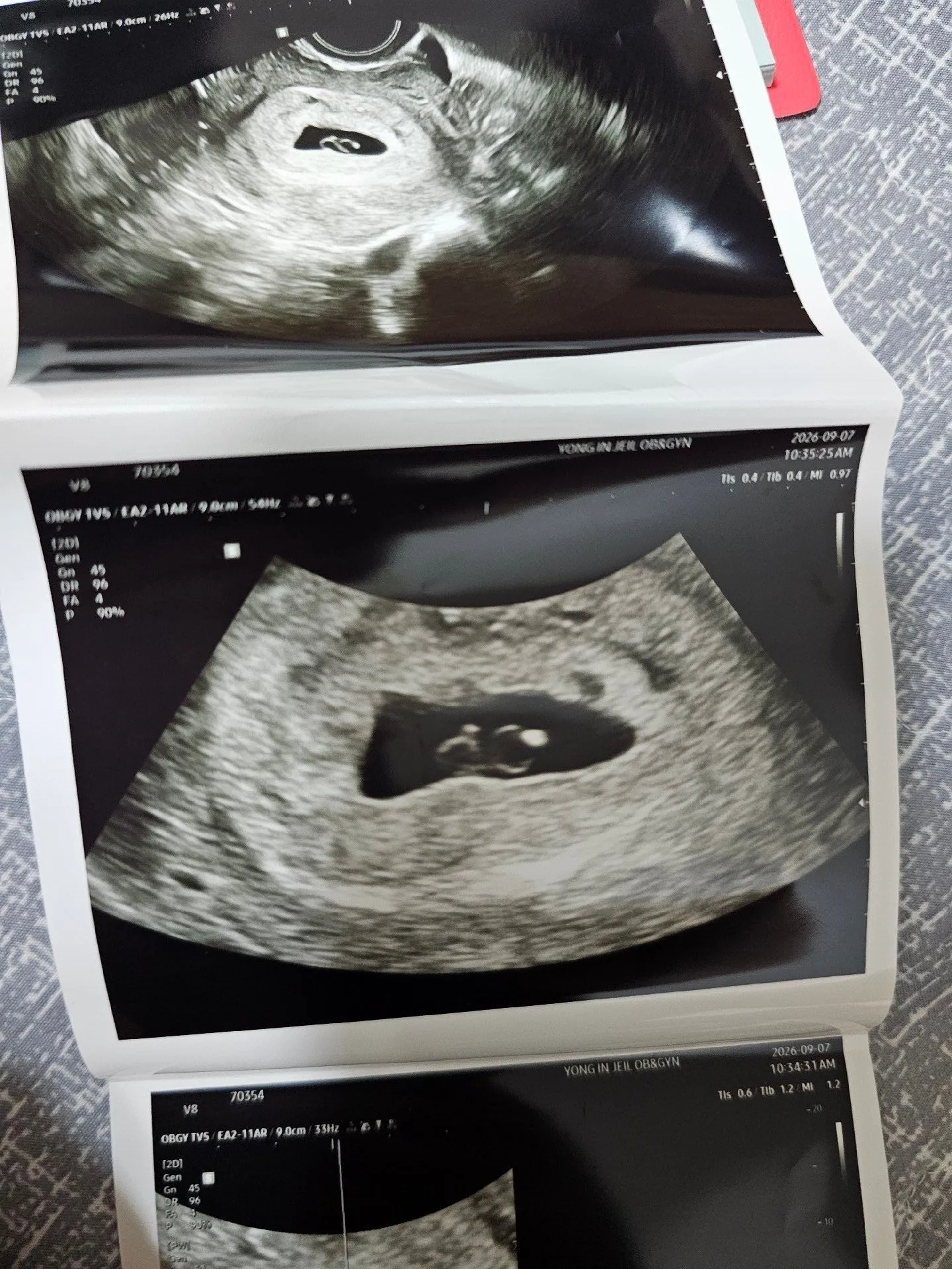 일란성쌍둥이 2