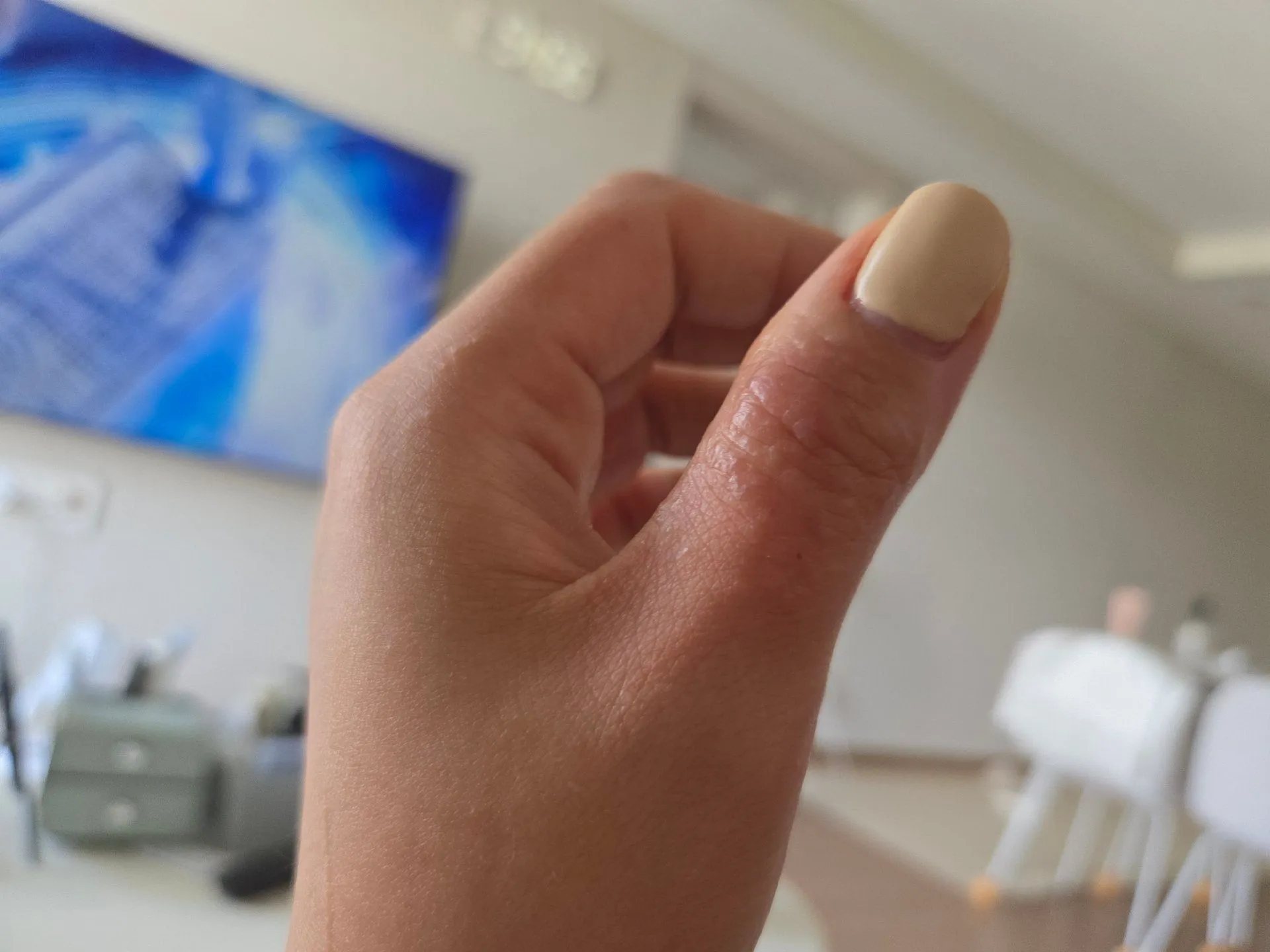 임신초기 한포진...아ㅜㅜ살려주세요 2