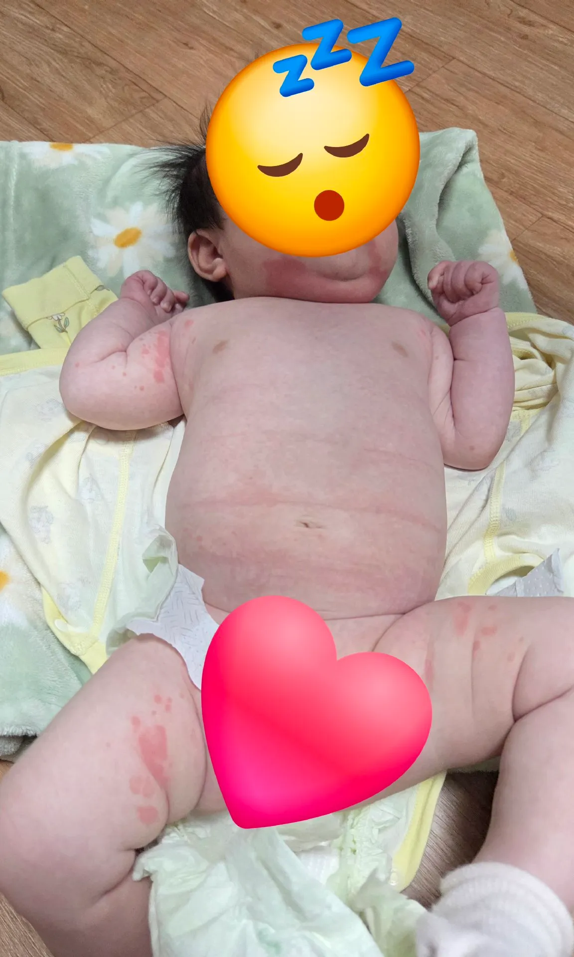 아기 두드러기 좀 봐주세요 (사진있음)