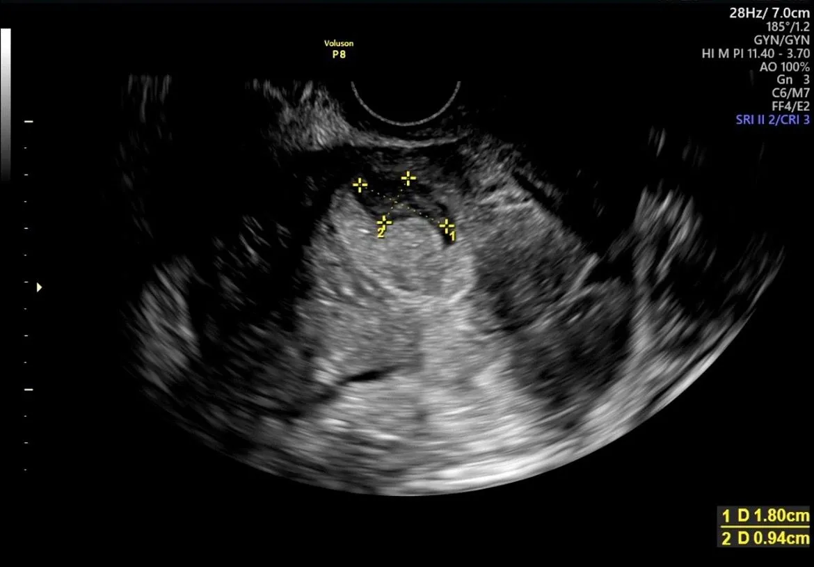 9w4d 피고임 봐주세요😭 1