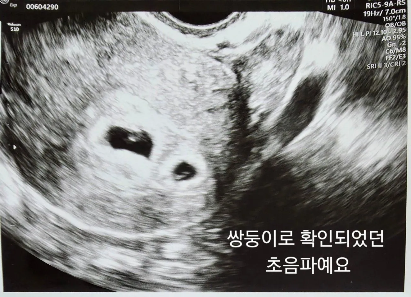 임신선배님들ㅠㅠ 1
